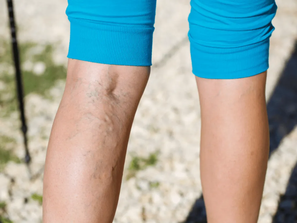 What To Know About Varicose Vein Treatment